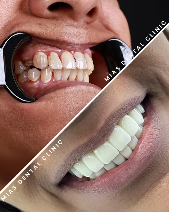 Dental İmplant & Tam Ağız Restorasyon 1