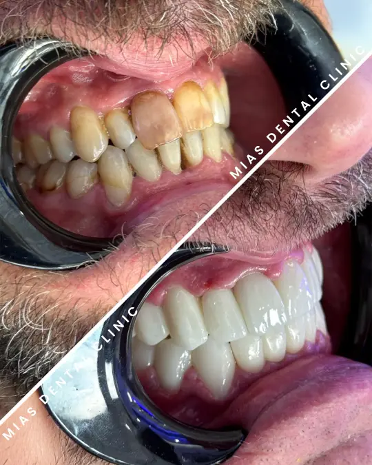 Estetik Gülüş Tasarımı & Zirkonyum Kaplama 3